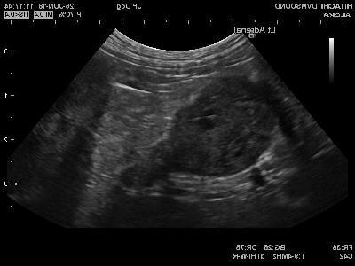 Adrenal Gland Cancer in Dogs Image 18