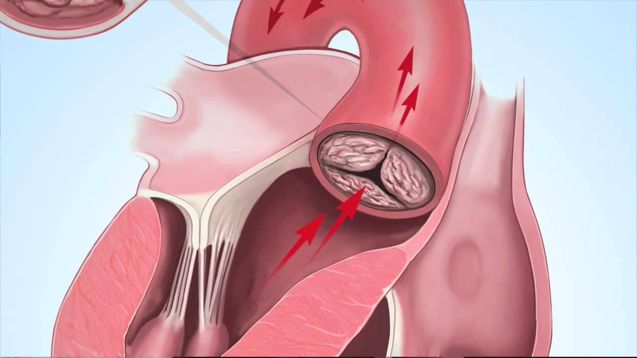 Aortic Stenosis Image 15