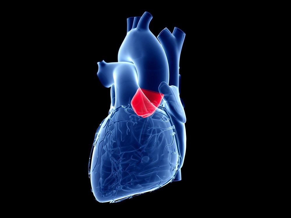 Aortic Stenosis Image 17