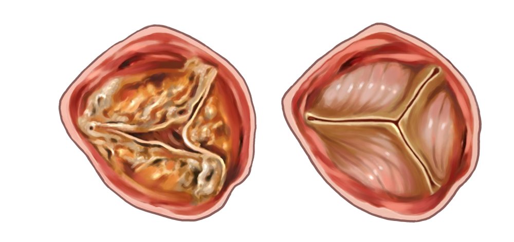 Aortic Stenosis Image 5