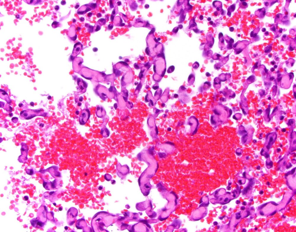 Hemangiosarcoma Image 2