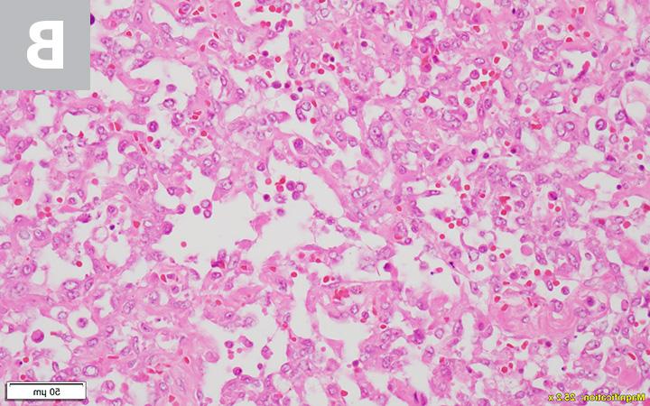 Hemangiosarcoma Image 4