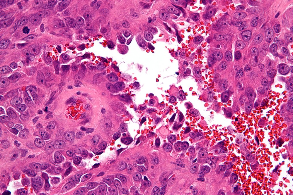 Hemangiosarcoma Image 7