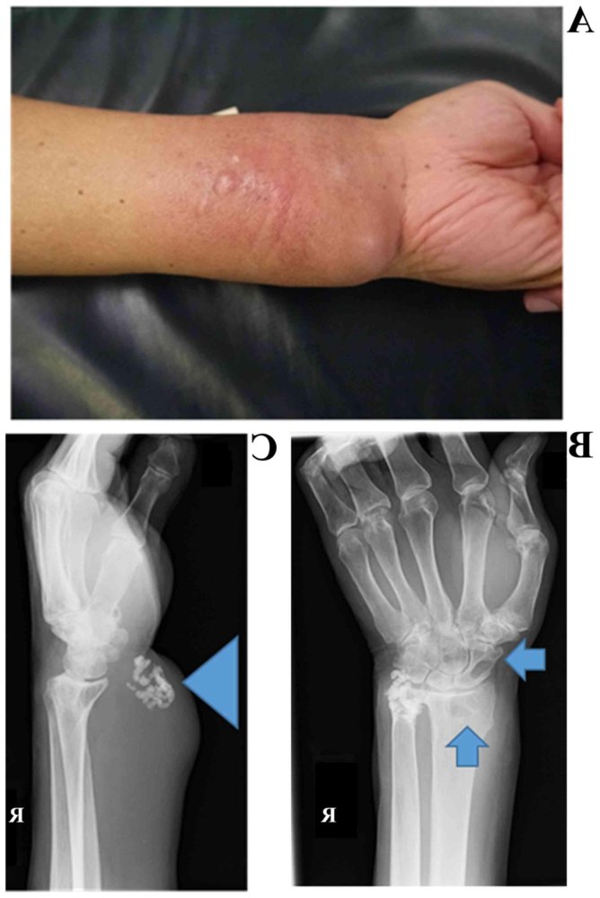 Soft Tissue Sarcoma Image 11