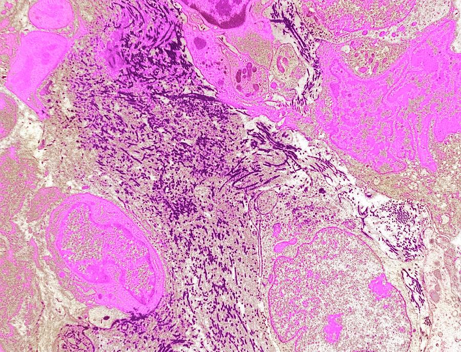 Soft Tissue Sarcoma Image 18